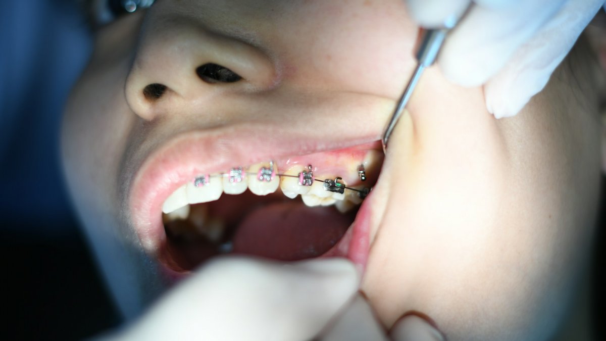 person with silver teeth braces